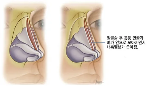 절골술 후 콧등 연골과 뼈가 안으로 모아지면서 내측 밸브가 좁아진 상태를 설명하는 그림