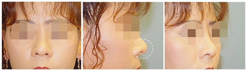 복합적인 원인의 코재수술 사례 02 사진 1 - 리숨성형외과
