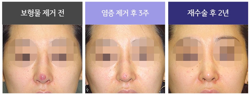 복합적인 원인의 코재수술 사례 08 사진 2 - 리숨성형외과