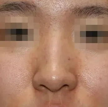 코끝 날개연골 정면