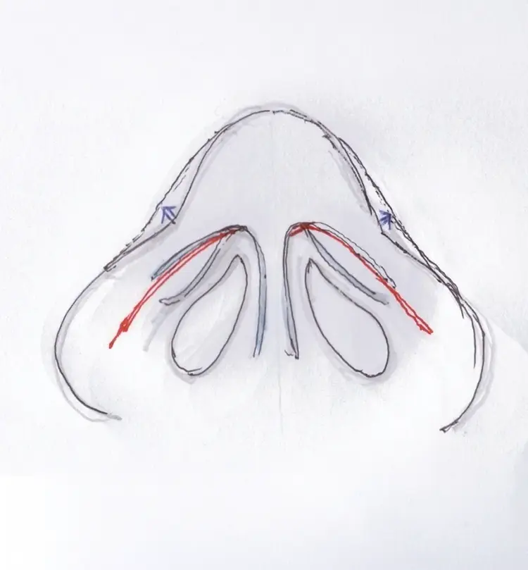 A. Pinching 교정 원리