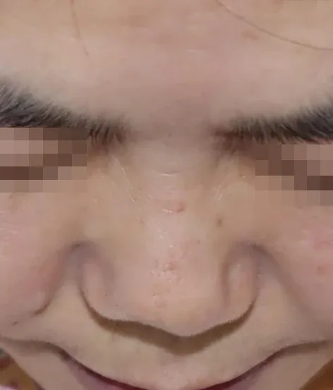 코끝 날개이식 임상 사진