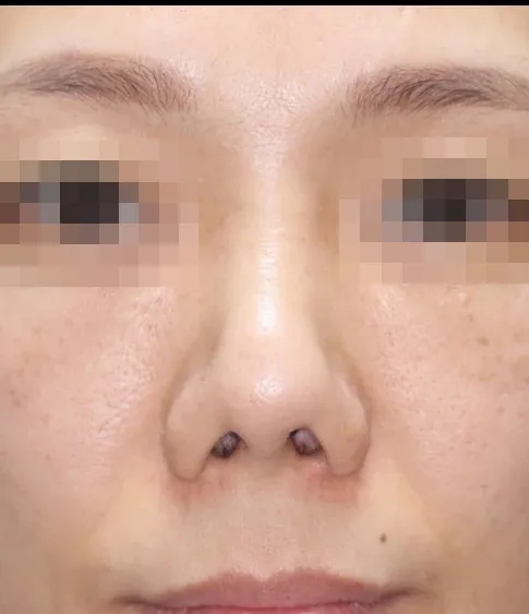 코끝 날개이식 임상 사진