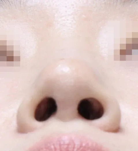 코끝 날개이식 임상 사진