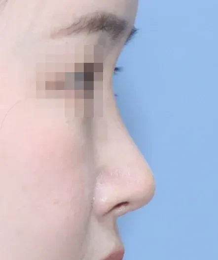 코끝 날개이식 임상 사진