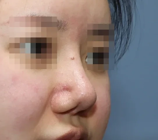 코끝 날개이식 임상 사진