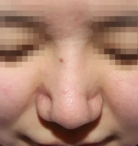 코끝 날개이식 임상 사진