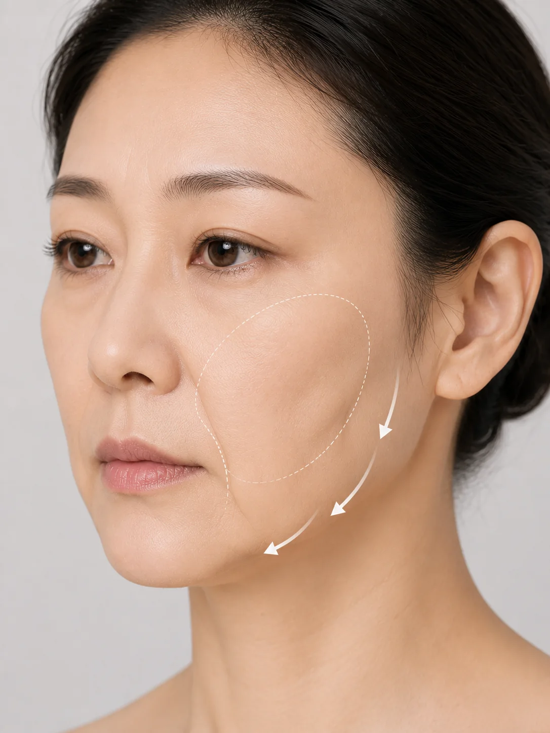 팔자 실리프팅과 팔자필러 비교