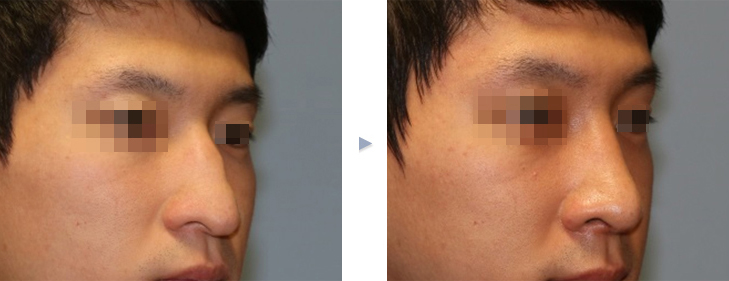 화살코, 처진 코끝을 어떻게 올릴까? 설명 이미지