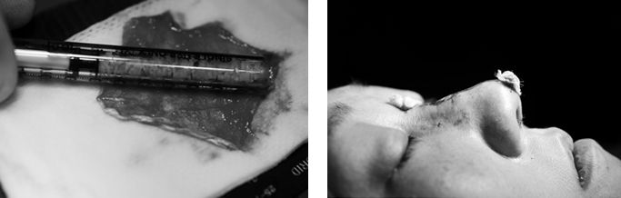 잘게 썬 귀 연골(diced cartilage)을 근막에 싸서 융비술 재료로 사용하는 모습