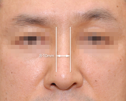 남자 코성형, 무엇이 다를까? 설명 이미지