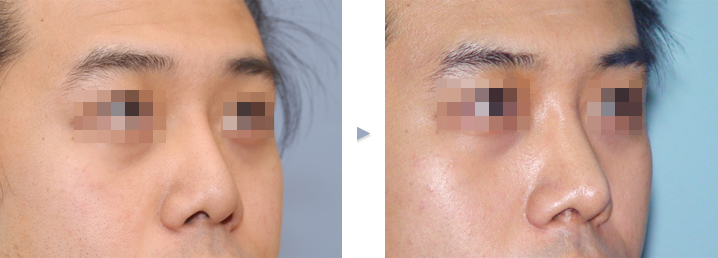 남자 코성형, 무엇이 다를까? 설명 이미지
