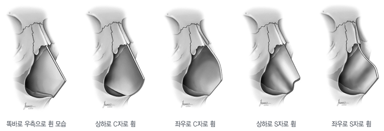 비중격 만곡증과 휜 코, 왜 같이 봐야 할까? 설명 이미지