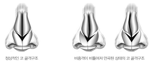내시경으로 본 코 내부의 모습