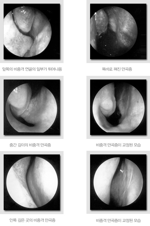 비중격 만곡증과 휜 코, 왜 같이 봐야 할까? 설명 이미지