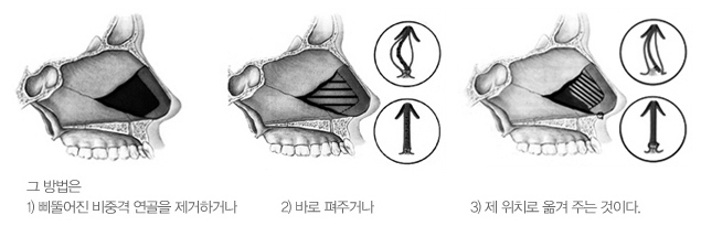 비중격 만곡증과 휜 코, 왜 같이 봐야 할까? 설명 이미지