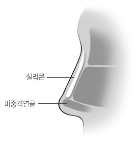 코끝성형 + 융비술