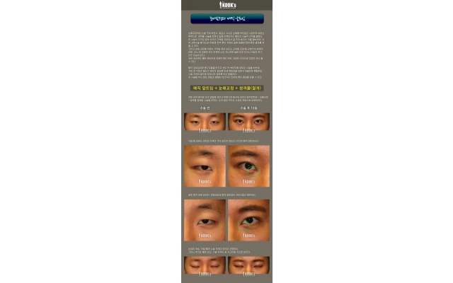 Ptosis Correction and Magic Epicanthoplasty