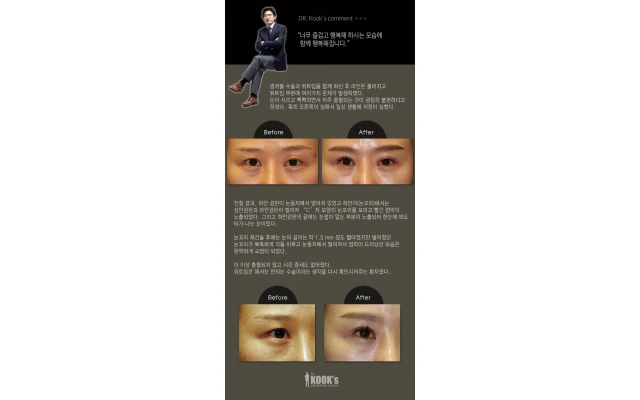 Lateral Canthal Reconstruction, Revision Eyelid Surgery