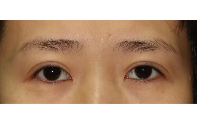 The Most Common Yet Difficult Type of Revision Double Eyelid Surgery ...