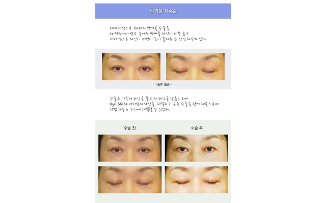 4th Revision Double Eyelid Surgery for a Woman in Her 50s