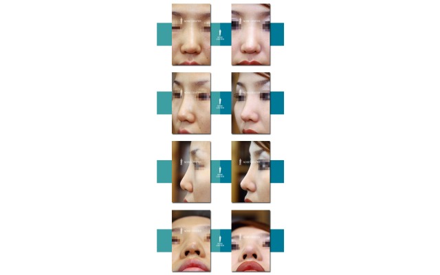 융비술을 하였으나 코끝이 오똑하지 않아서..