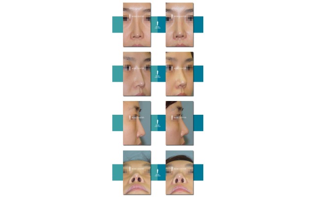 코 재수술 (자가조직 코성형)