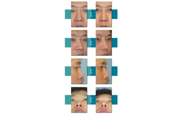 코등이 넓고, 울퉁불퉁하여, ..