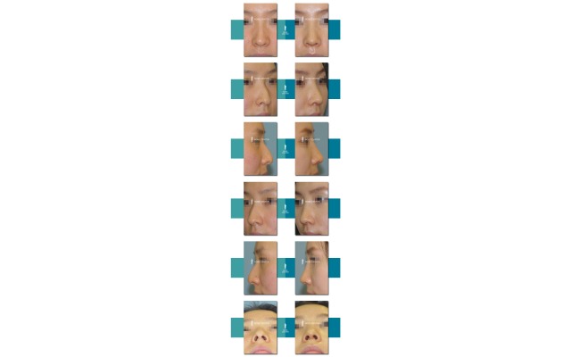 매부리코+휜코
