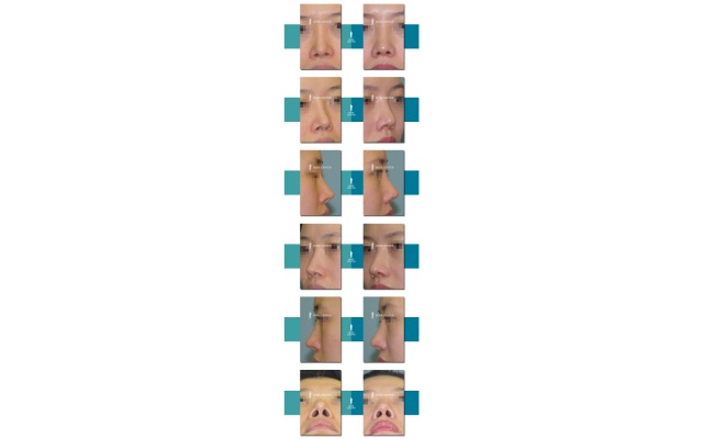 재수술(실리콘이 표시가 나고..)