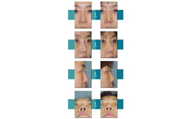 재수술 (실리콘이 비치고 , 삐뚤어지고..)