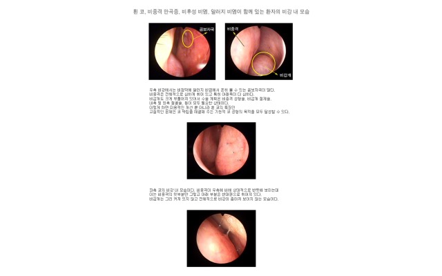 휜코, 비중격만곡증, 비후성 비염, 알러지비염이 있는 환자의 비강내 모습