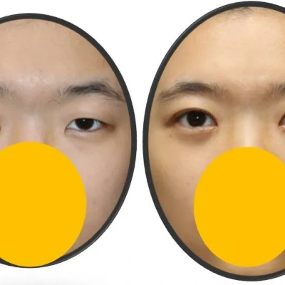 우리반 눈수술 짱 먹었어요^^