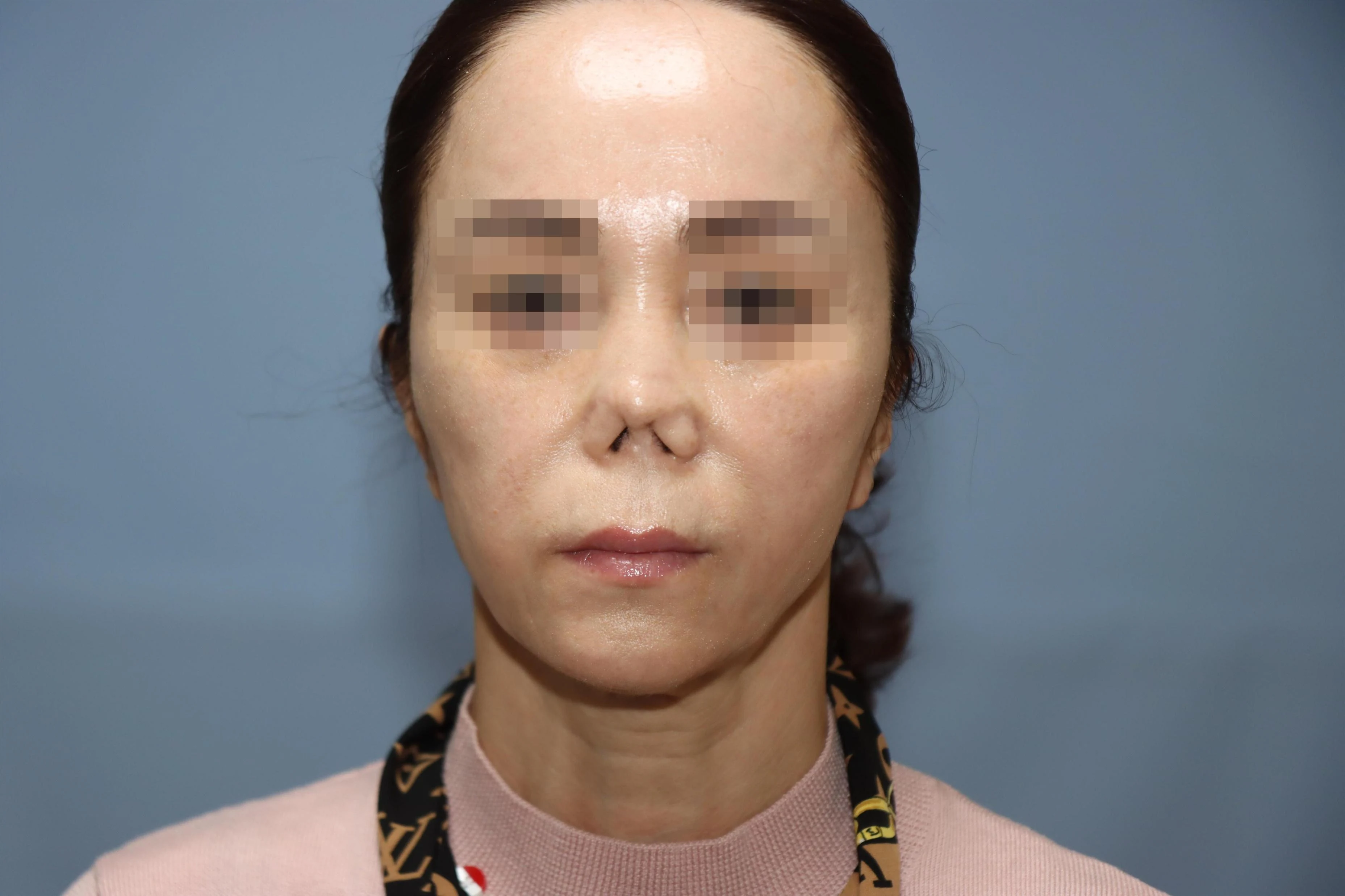 줄기세포 코성형 염증 제거 후 5달 비교 사진 3