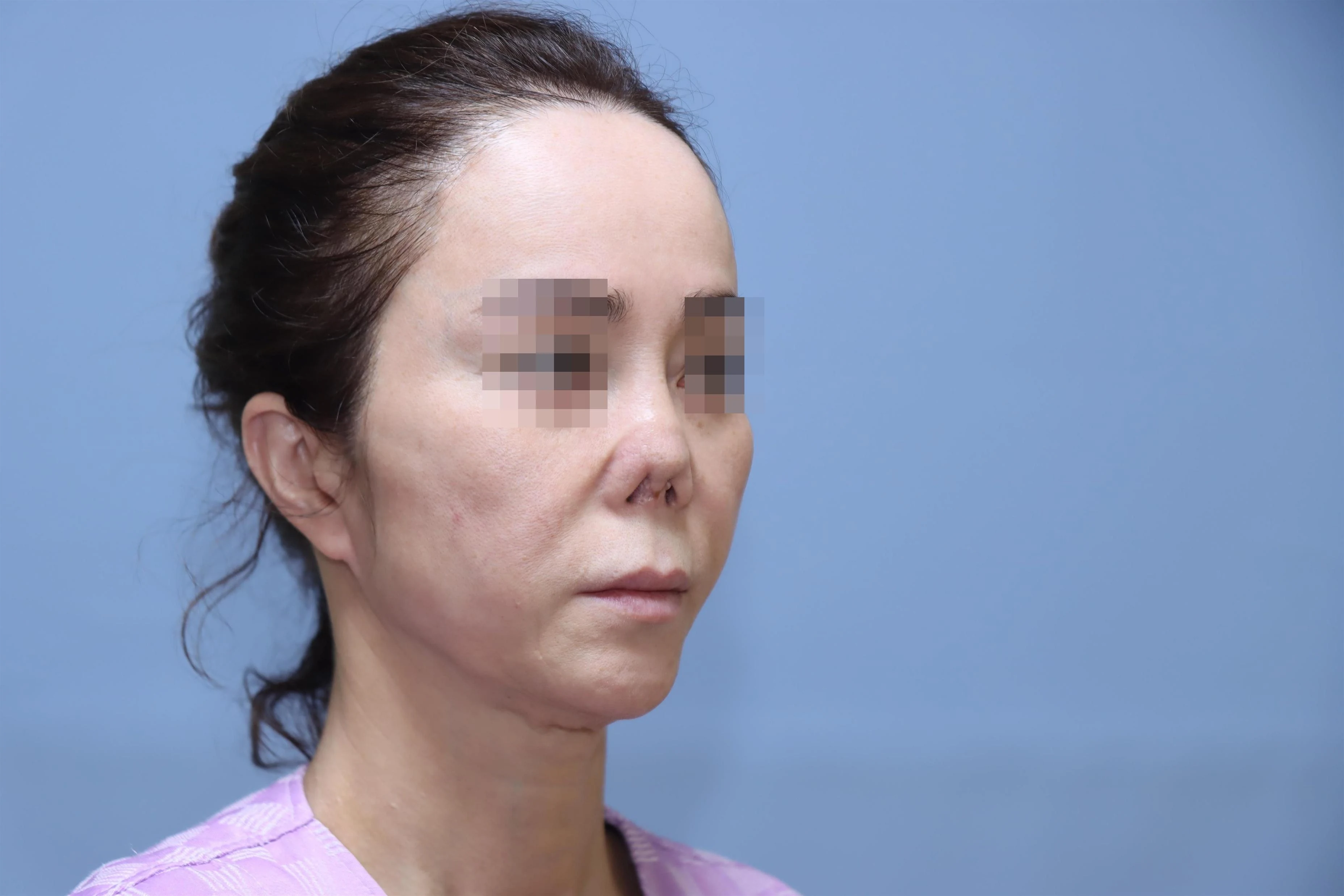 줄기세포 코성형 제거 전 비교 사진 1