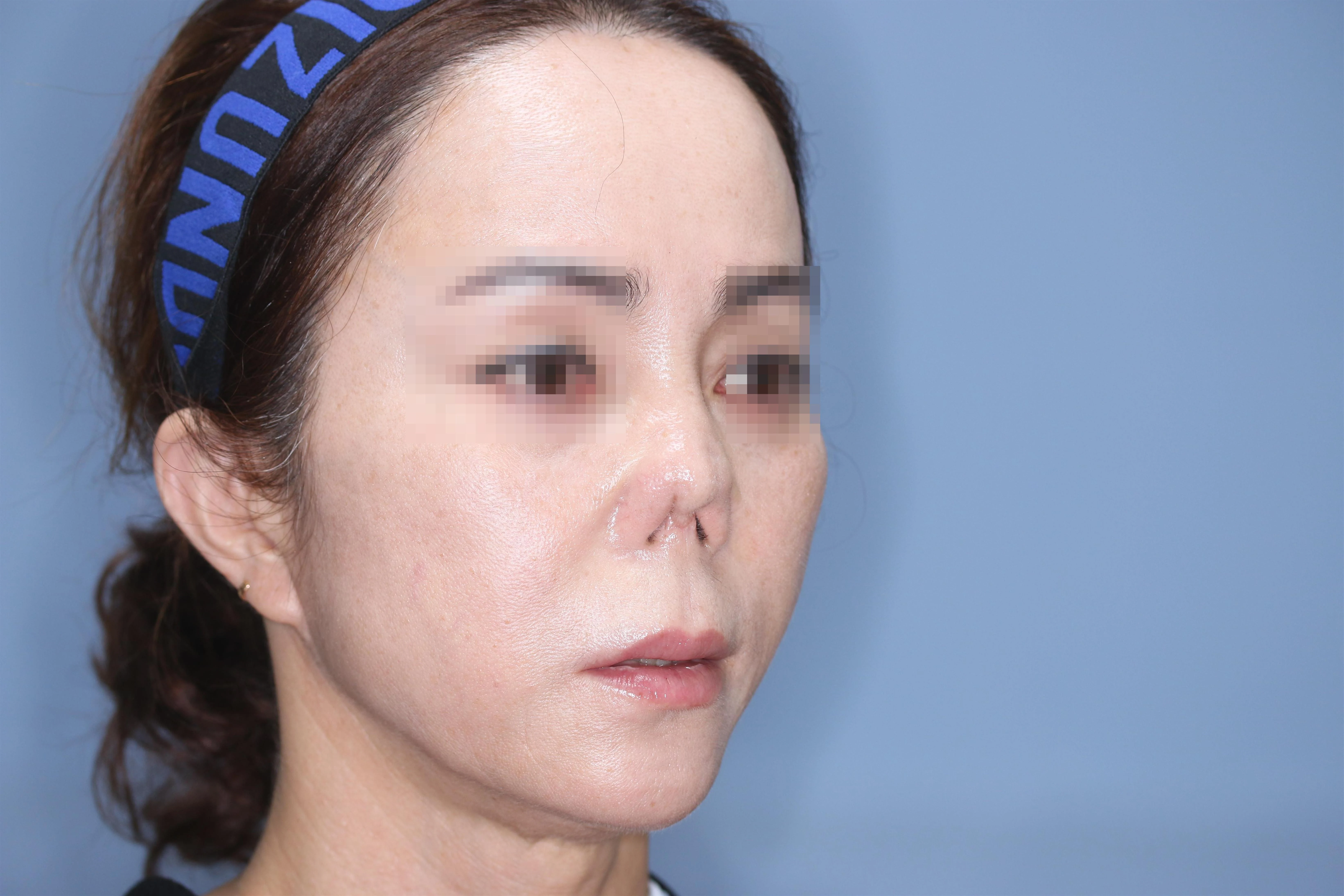 줄기세포 코성형 제거 후 1달 비교 사진 2