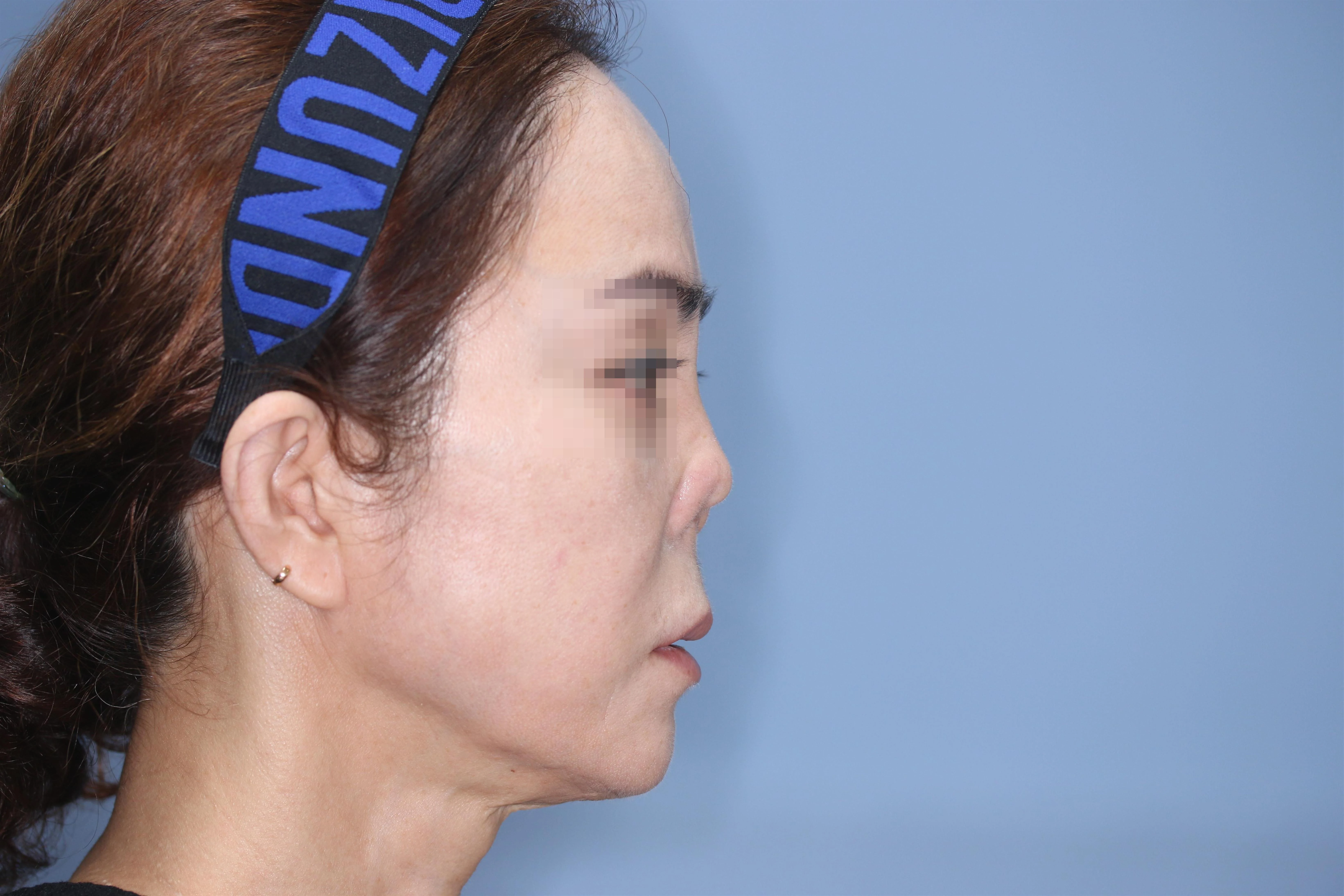 줄기세포 코성형 제거 후 1달 비교 사진 2