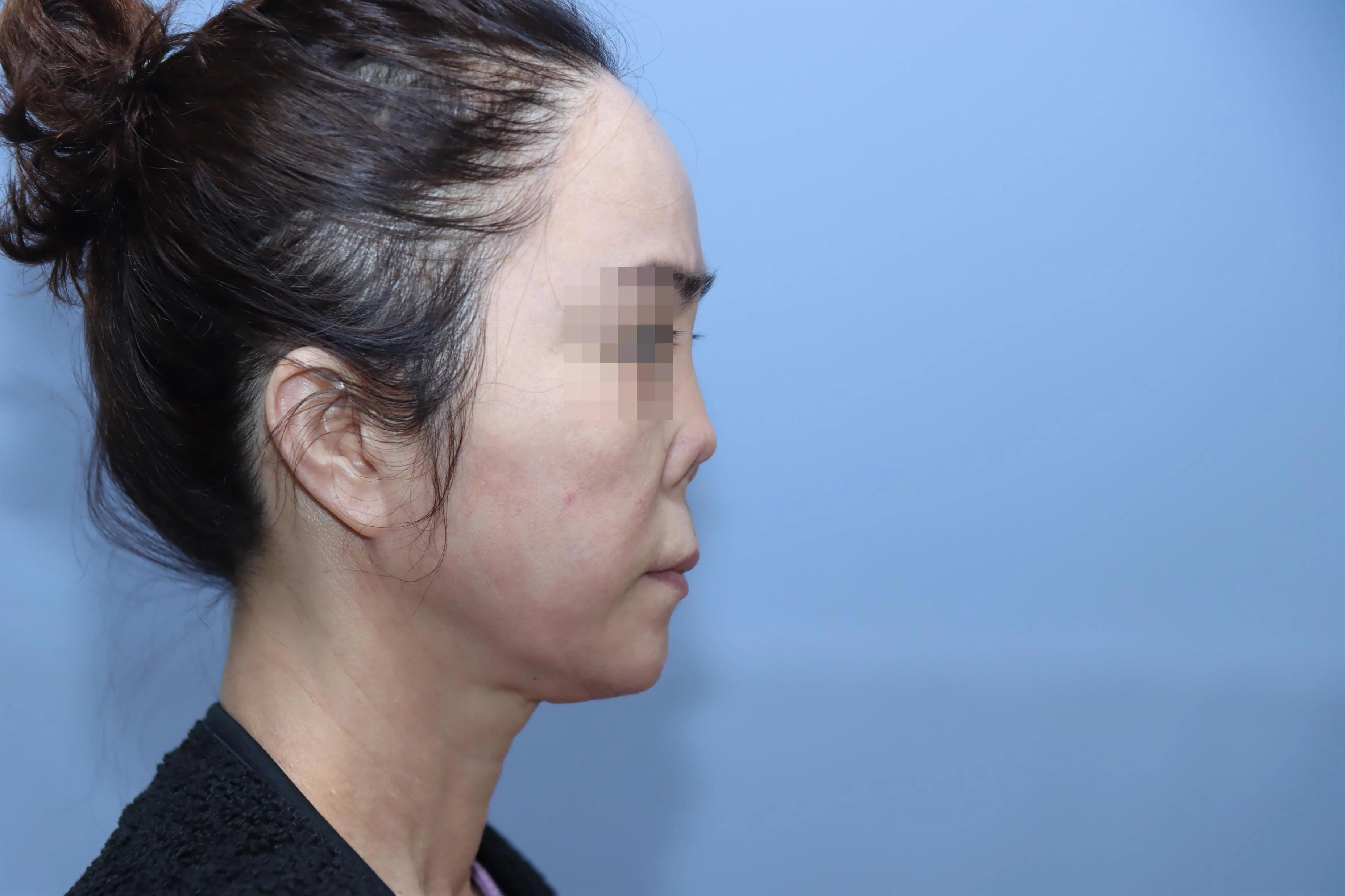 줄기세포 코성형 재건 수술 전 모습 비교 사진 2