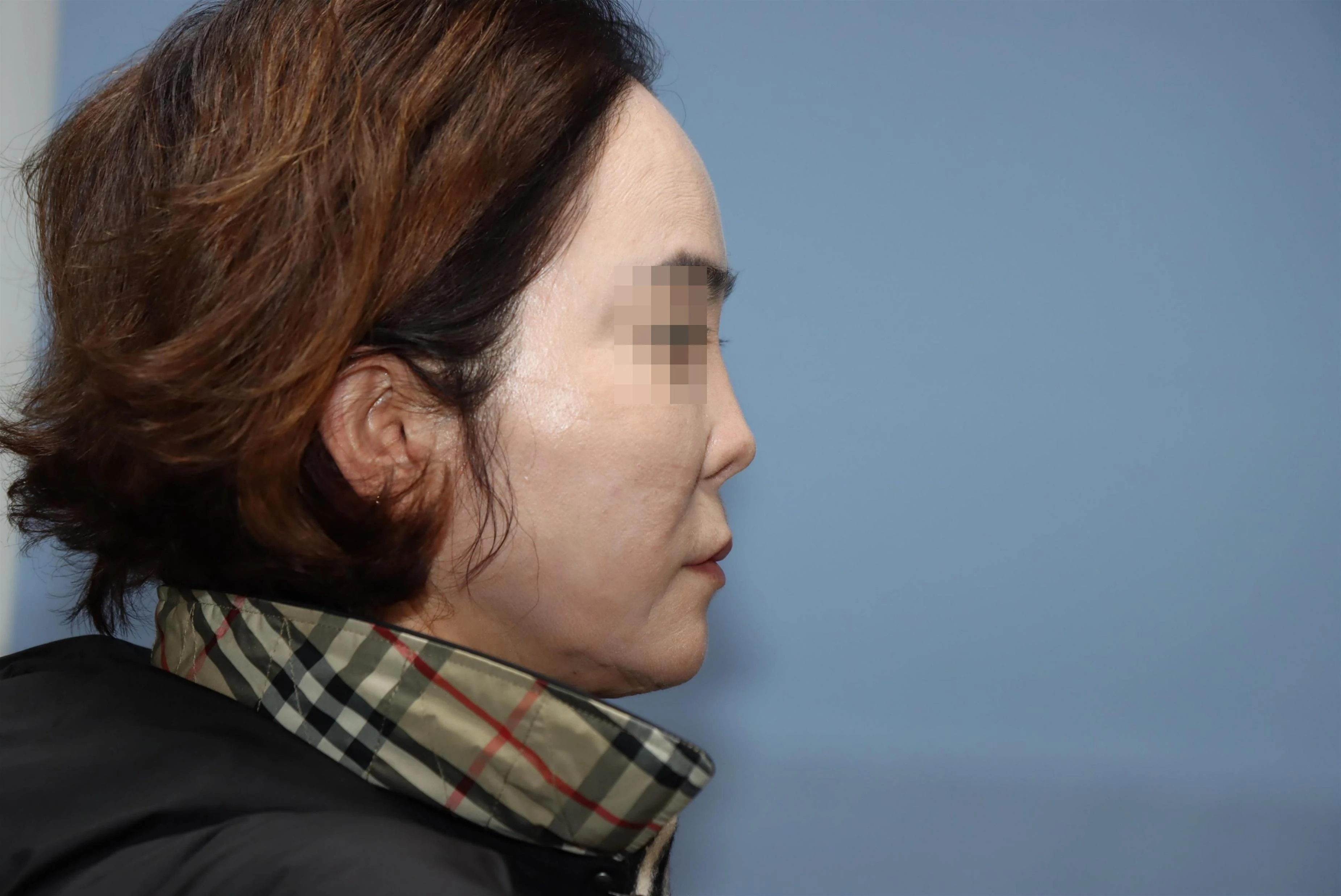 줄기세포 코성형 재건 수술 후 비교 사진 2