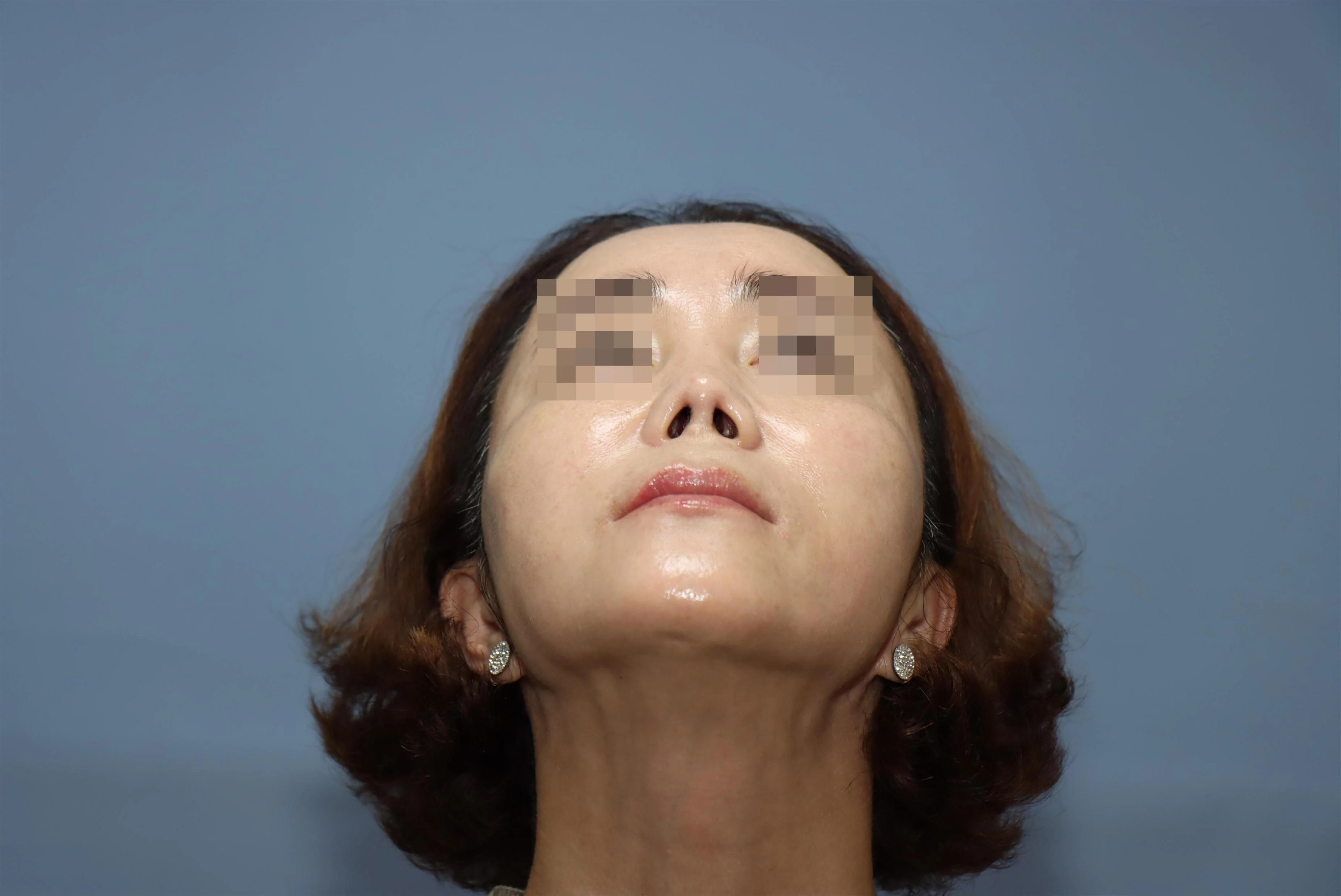 줄기세포 코성형 8개월 비교 사진 2