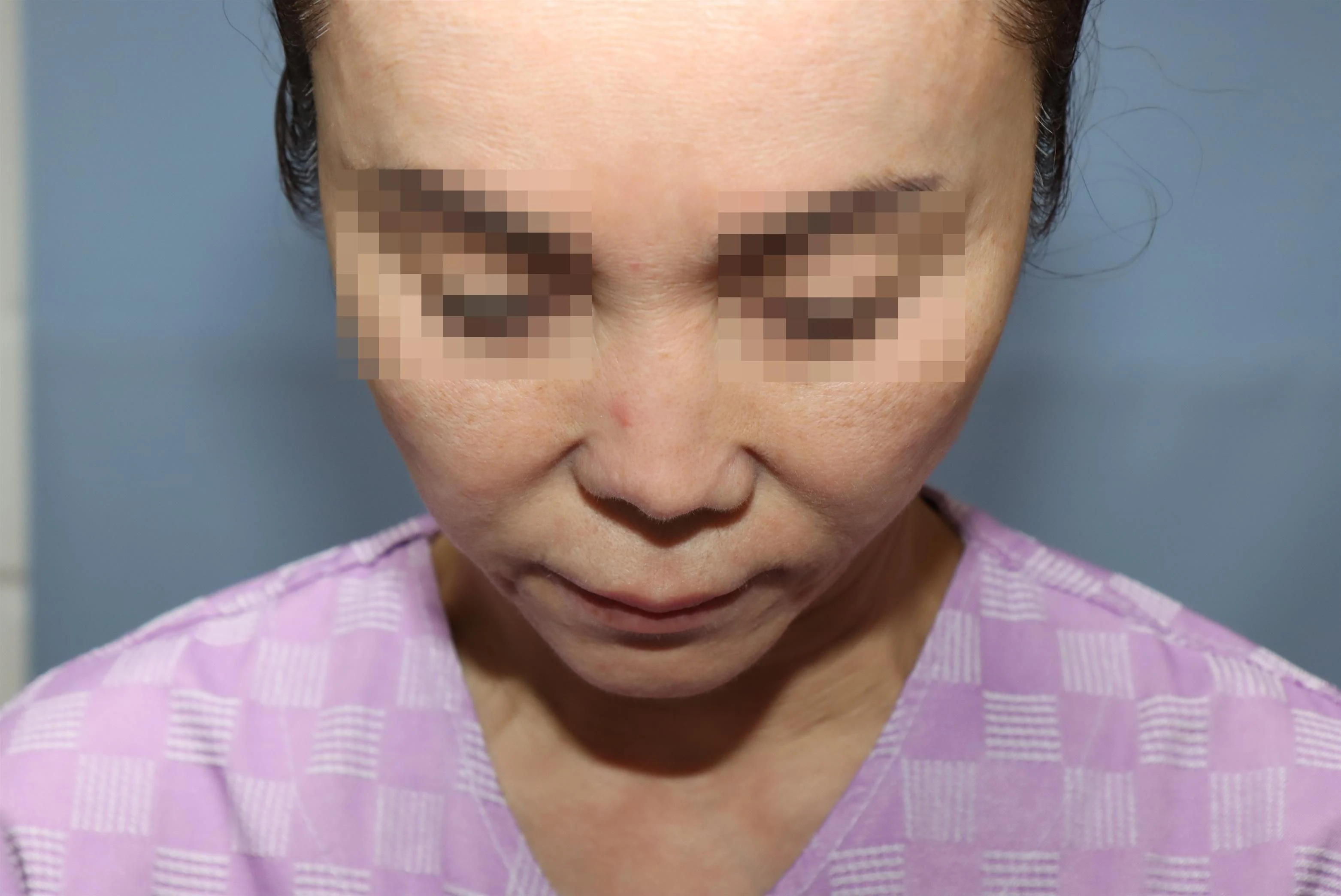 줄기세포 코성형 1차 재건 수술 후 2년 비교 사진 3
