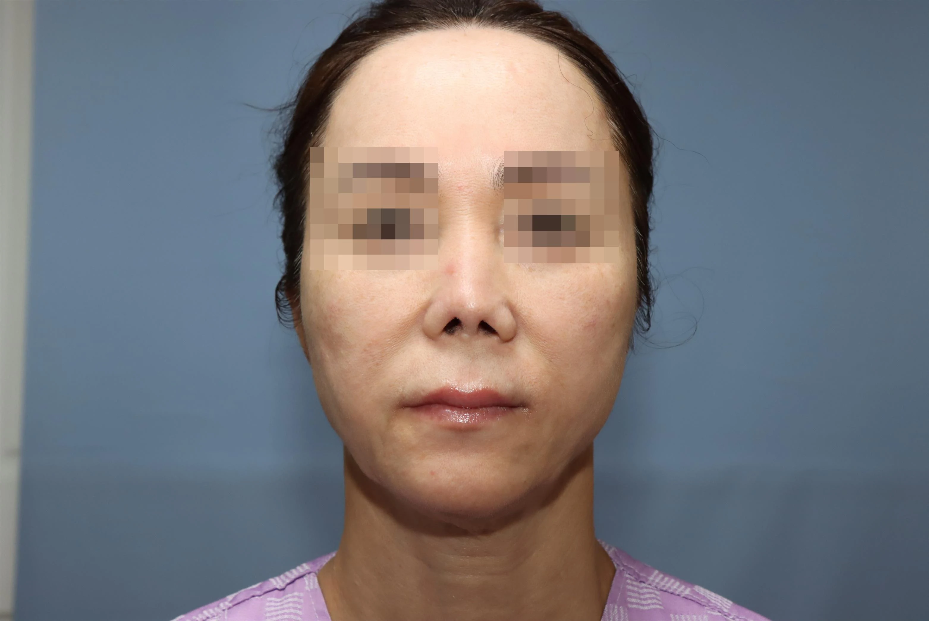 줄기세포 코성형 수술 전 비교 사진 1