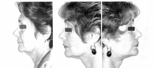 3. 턱밑 피판술 (Submental flap technique)
