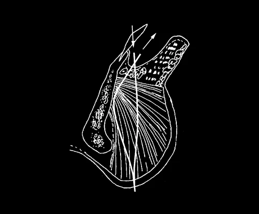 5. 실 리프팅, 근육 묶기, 레이저 치료, 지방흡입, 아큐주사, 브이 슈링크, 울세라 관련 자료