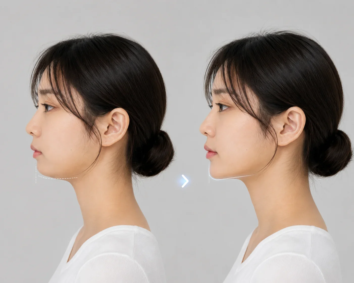 부위별 상태에 맞는 설계(점탄성·주입층)
