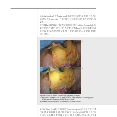 [메디컬S] 2015년 11월호 : 안면거상술  High SMAS Face Lift(1)