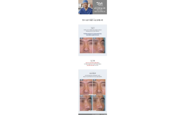 Male Revision Rhinoplasty 04: Correcting an Unsatisfactory Result of Deviated Nose Surgery
