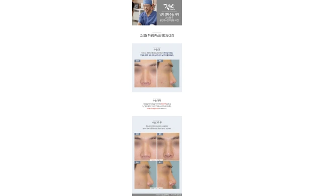 Male Revision Rhinoplasty 05: Correcting an Unsatisfactory Shape After Rhinoplasty