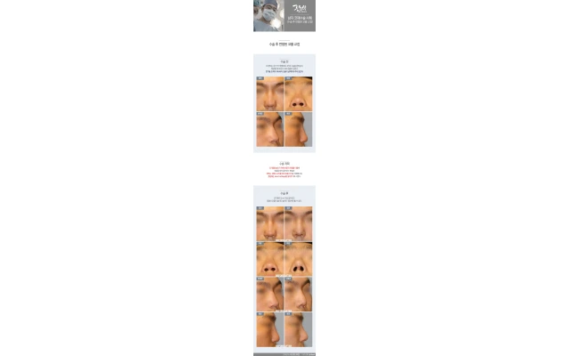 Male Revision Rhinoplasty 07: Correcting a Nose Deformed After Surgery