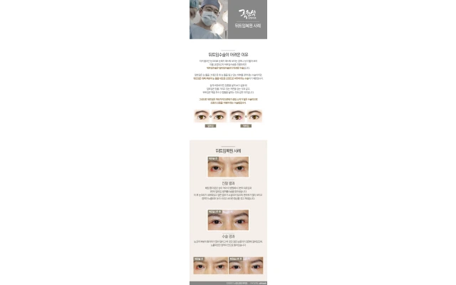 Lateral Canthoplasty Reversal Case 01